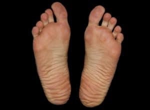 Doigts de pieds engourdis : causes et solutions pour un confort retrouvé